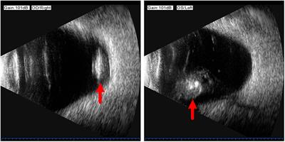 Case report: Spontaneous bilateral intraocular lens dislocation in a patient with homocystinuria